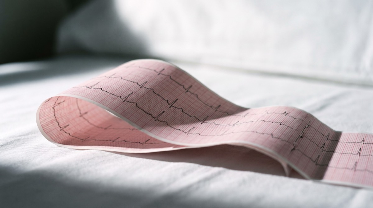 Coronary artery disease (illustrative image)