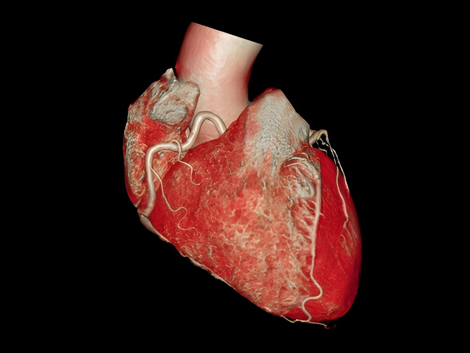 3D reconstruction of the heart and coronary arteries from a CT coronary angiogram