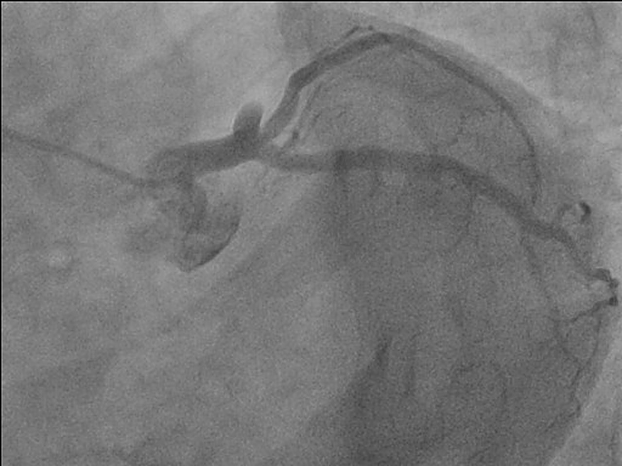 Coronary angiogram showing the left anterior descending artery completely blocked at its start