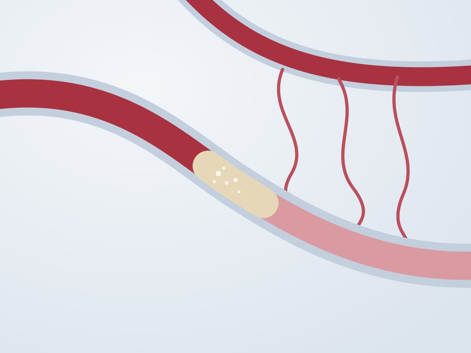 Diagram of a completely blocked coronary artery, with small collateral vessels carrying blood around the blockage